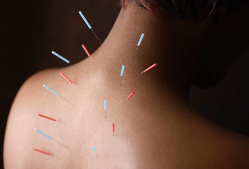Acupuncture – Holliday&Venter